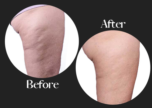 sculptra before and after